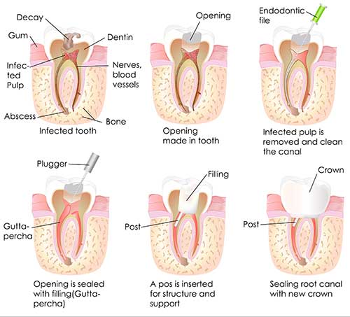 Chester Endodontics